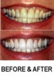 /album/crest/teeth-before-after-jpg/